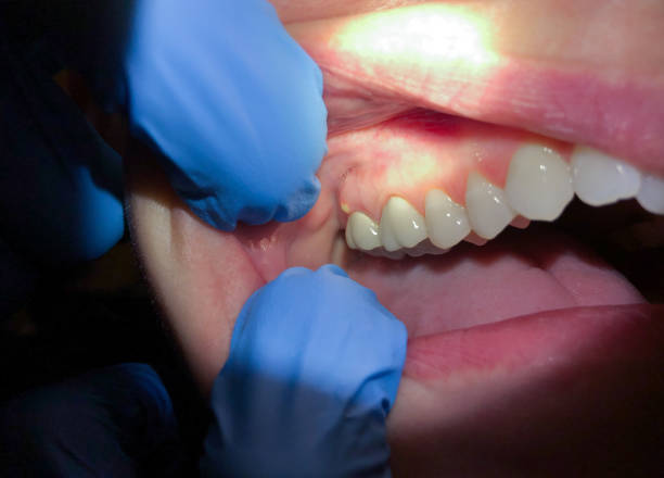 Best Emergency Dental Care for Broken or Chipped Teeth in Penns Grove, NJ